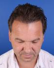 After Hair Transplant&nbsp;Temporal Hairline